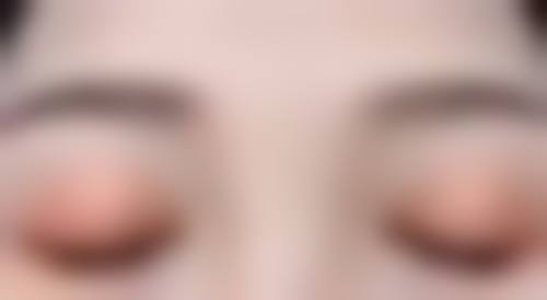 二、小腿有手术疤痕可以当兵吗？疤痕大小与位置的影响