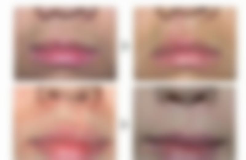 七、有骨膜贴片隆鼻吗？骨膜贴片隆鼻的风险问题