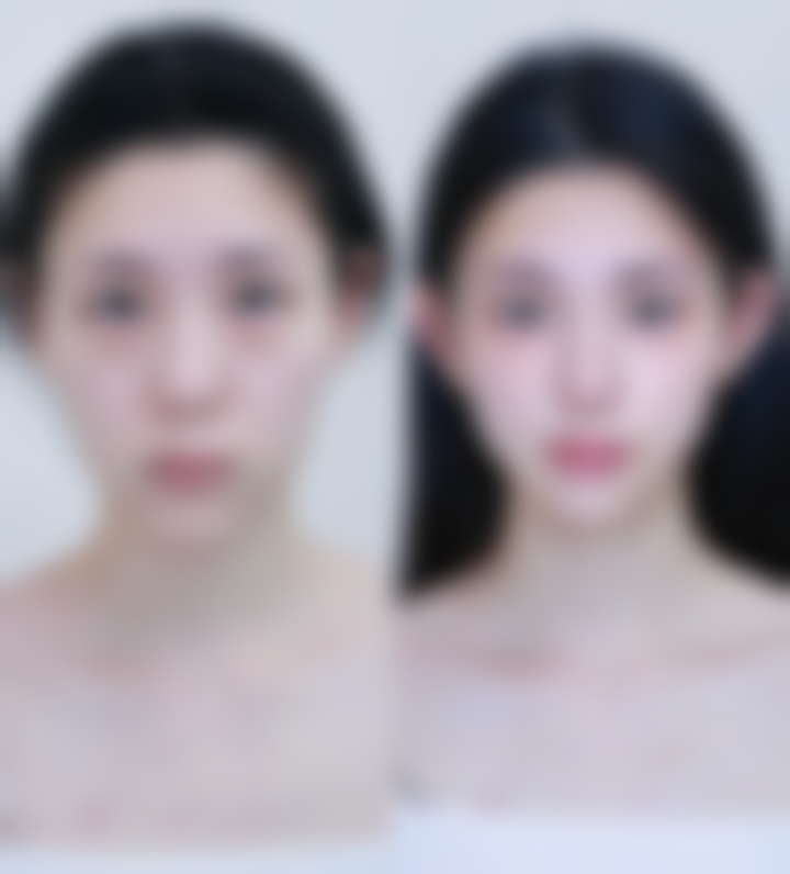 一、做完双眼皮躺着睡的可行性及睡姿建议