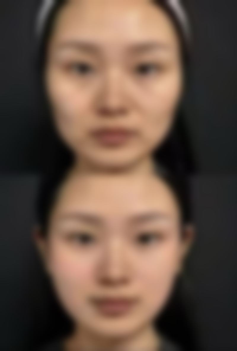 烫伤疤痕印怎么去掉？多种有效方法助你淡化烫伤印，重获光滑肌肤！ 