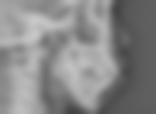 五、如何祛除黑眼圈眼袋之医美方案注意事项