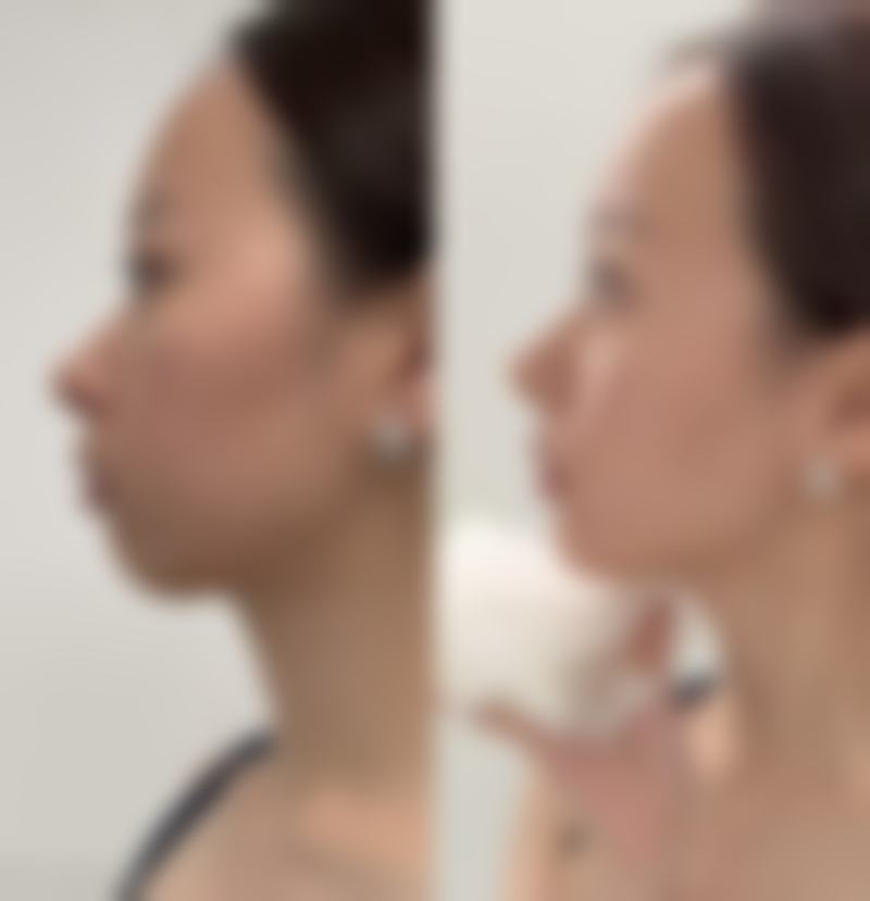 二、常见的医美手术方法