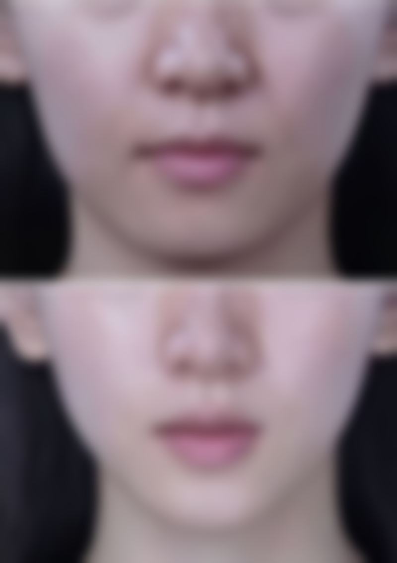 一、如何祛除黑眼圈眼袋之原因判断