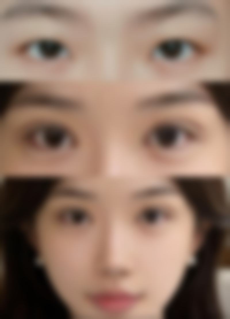 做了眼袋手术多久可以恢复自然？恢复期间能否打耳洞一文为你解答 