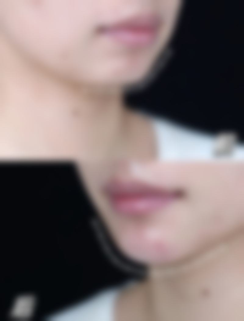 四、重度眼袋的应对办法