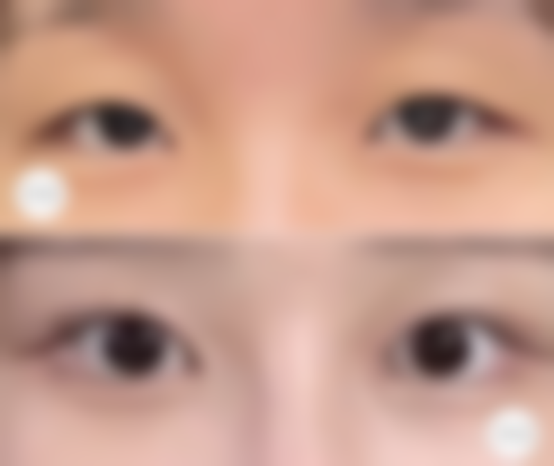 化妆品去眼袋有用吗？深入剖析其效果、局限及日常护理建议