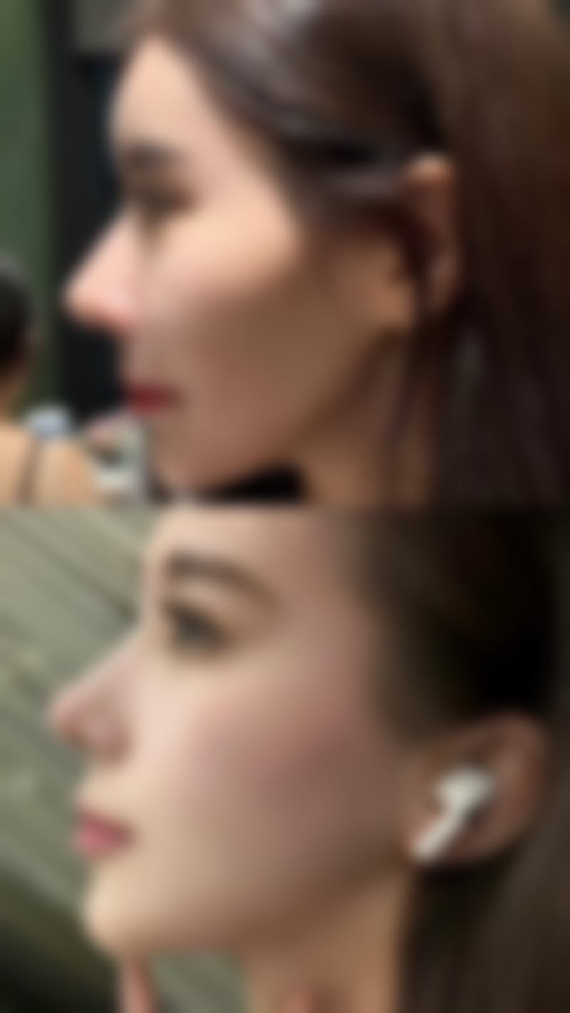 三、手术隆鼻需要全麻吗之患者耐受度的影响