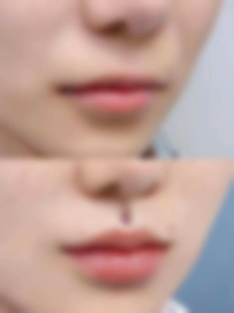 二、不同手术方式下做完双眼皮手术多久消肿