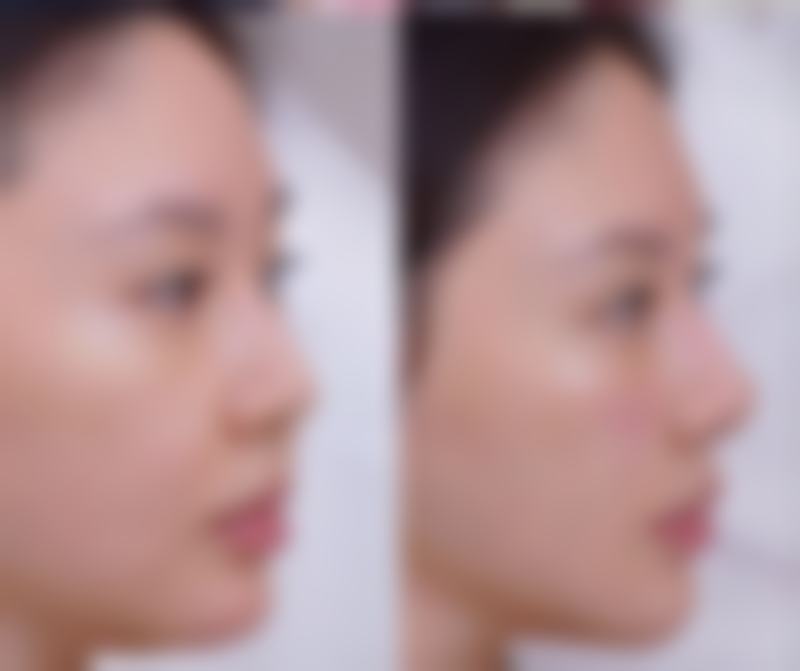 三、哪双眼皮修复做的好——沈阳医生推荐