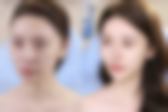 手术隆鼻需要全麻吗？答案由手术方案、患者耐受度和身体状况共同决定 