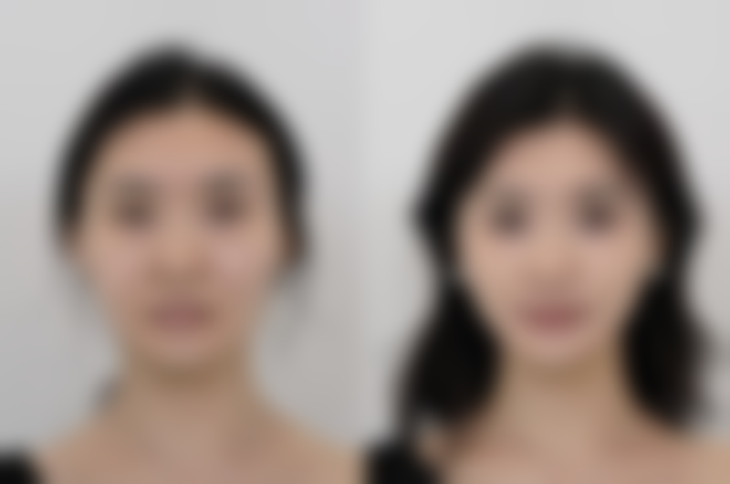 什么去除眼袋效果最好？多种方法大揭秘，助你找到最适合的方案！ 