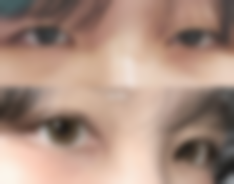 一、了解眼袋形成的原因