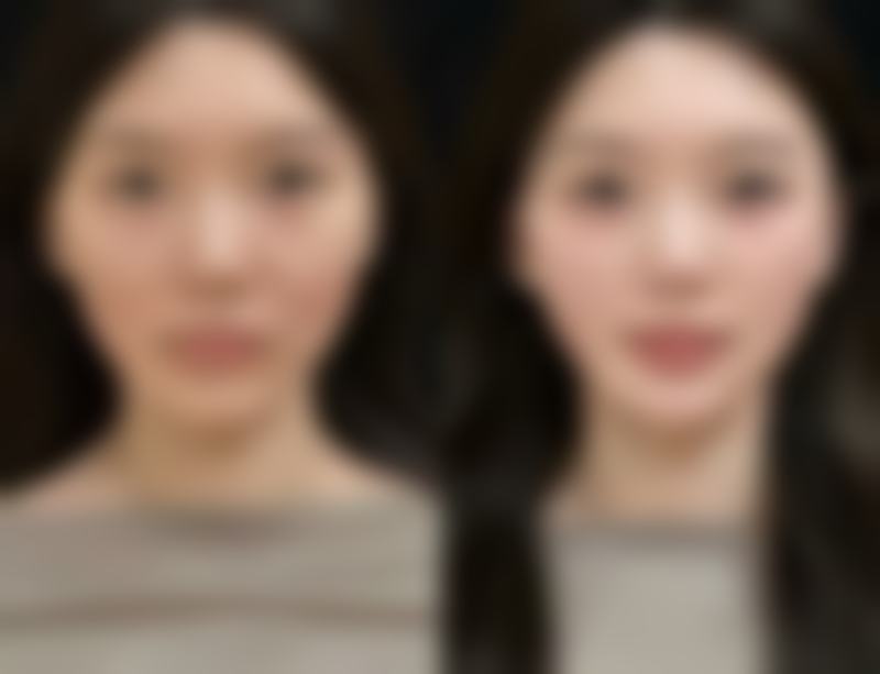 三、山茶油去眼袋的实际成效