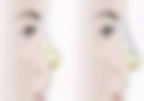 怎么去除疤痕疙瘩最快最有效？多维度治疗方案与美学管理助你恢复皮肤平整