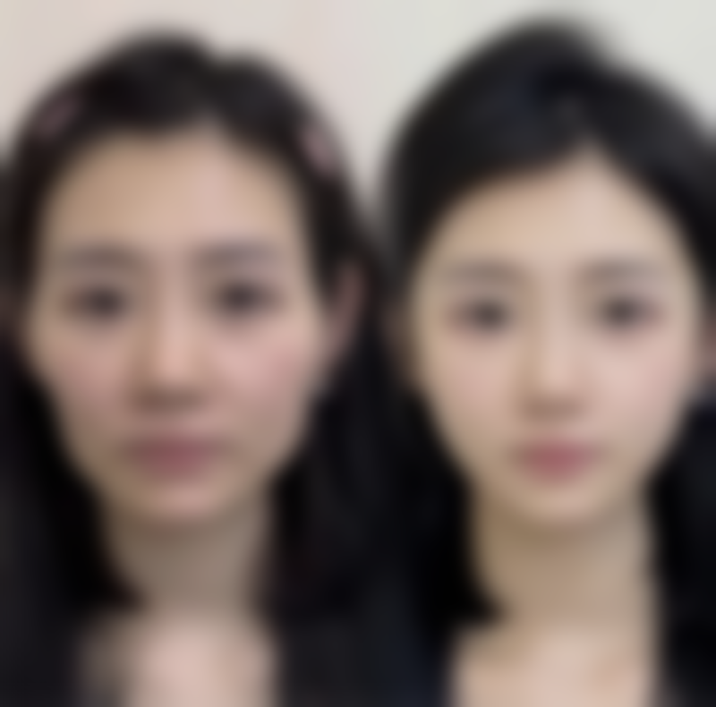 七、去除疤痕色素要有耐心