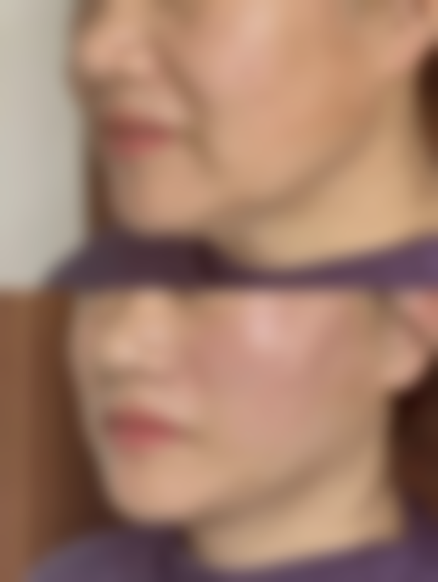 二、注射隆鼻的重度血管并发症及危害