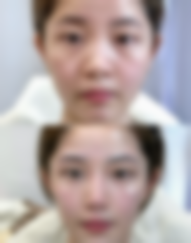 怎么才能除疤痕体质？掌握预防、医美及综合疗法助你改善疤痕外观降低风险