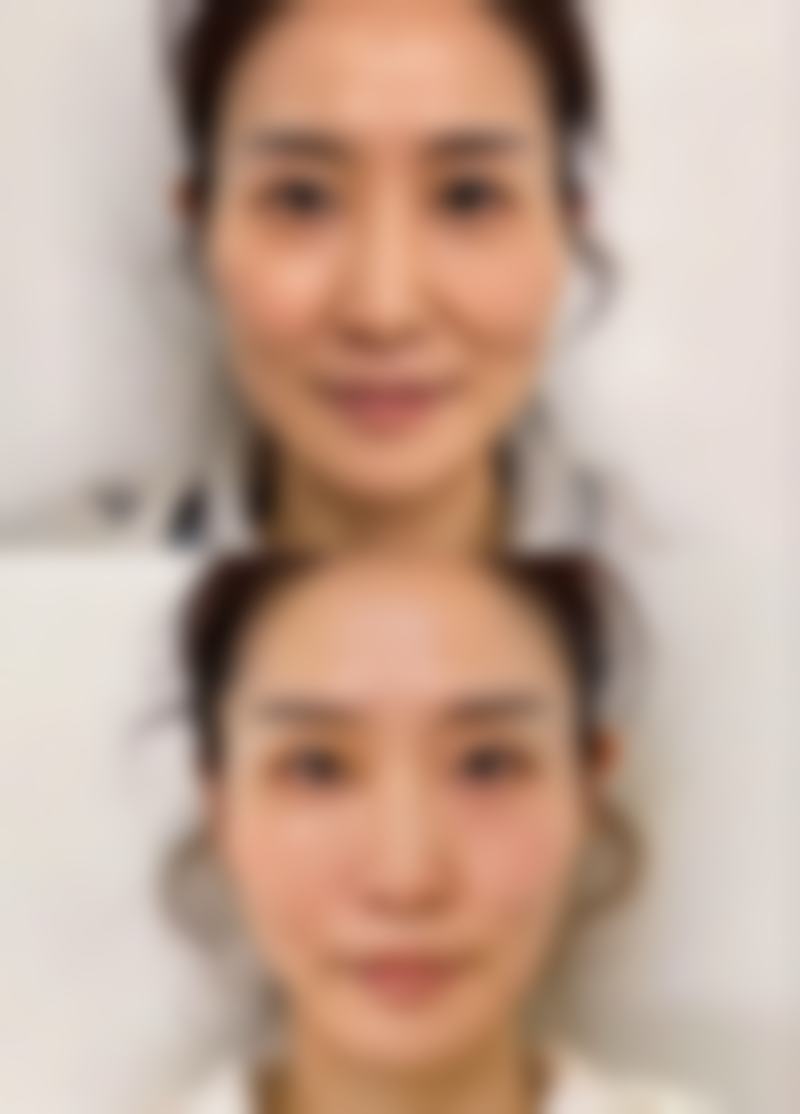 三、青春魔法棒除皱成效怎么样之与其他除皱方式对比