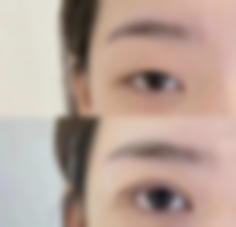 六、怎么才能除疤痕体质之注意事项