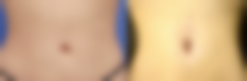 六、韩国爱她(ATOP)整形外科价格表