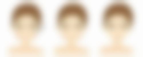 三、如何降低切开双眼皮的风险和后遗症