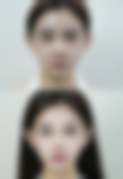 四、疤痕增生厉害治疗的风险提示与美学建议