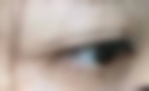 五、缝过针的疤痕就医时机与建议