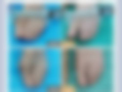 一、拉双眼皮眼睛充血的原因