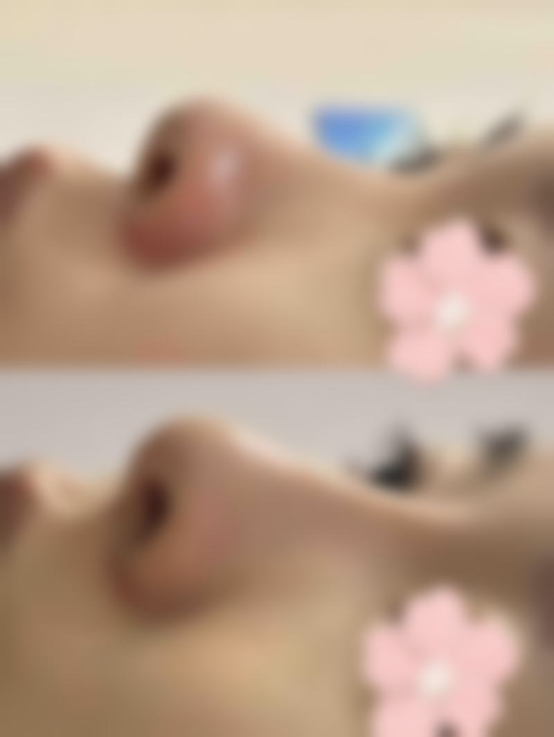 六、疤痕增生可以用维生素E吗？日常护理不能忘