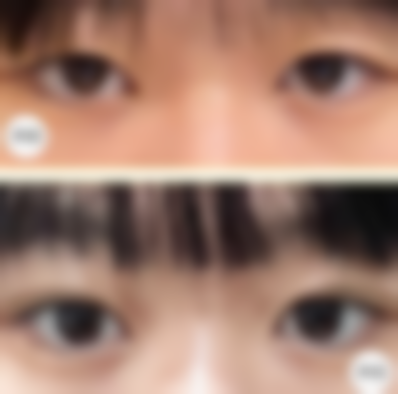 一、打完瘦脸针躺姿的重要性