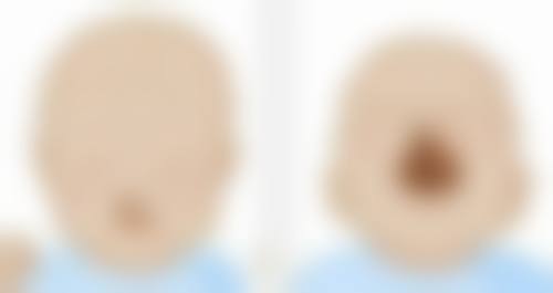 二、7.5 毫米的双眼皮适合哪些人