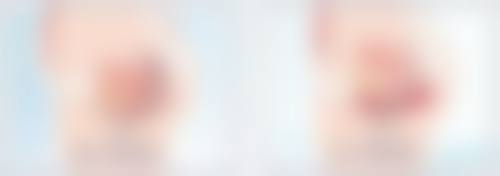 二、耳软骨隆鼻鼻尖显形的修复方案与护理建议