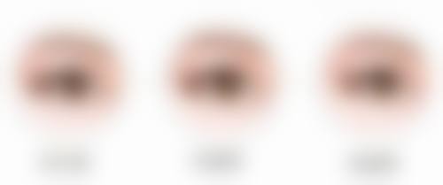 六、实例分析 7.5 毫米的双眼皮成效