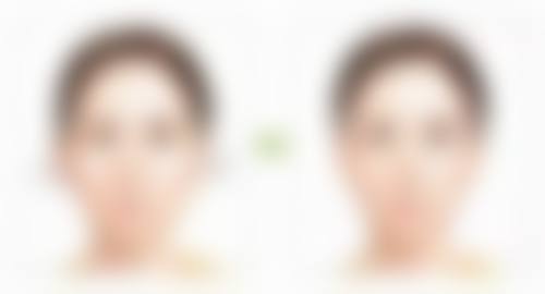 五、确定 7.5 毫米双眼皮宽度时的注意事项