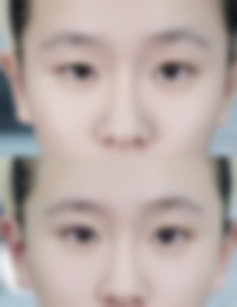 二、面部吸脂多久能看到成效