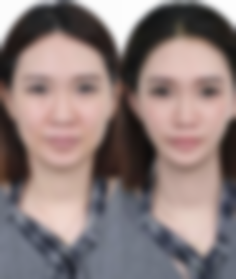 三、7.5 毫米的双眼皮在修复期的变化