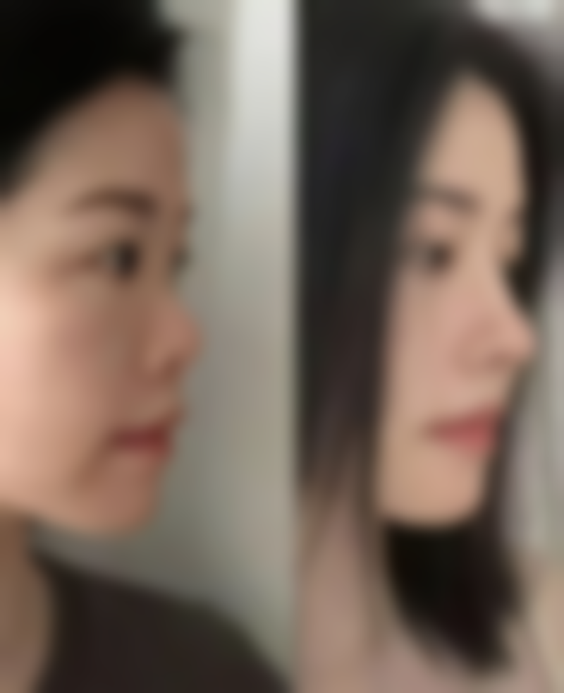 7.5毫米的双眼皮宽吗？是否好看需结合眼部条件、审美偏好等综合判断！ 