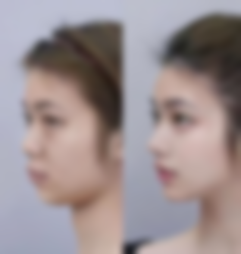 一、做双眼皮一般修复要多久之手术方式影响