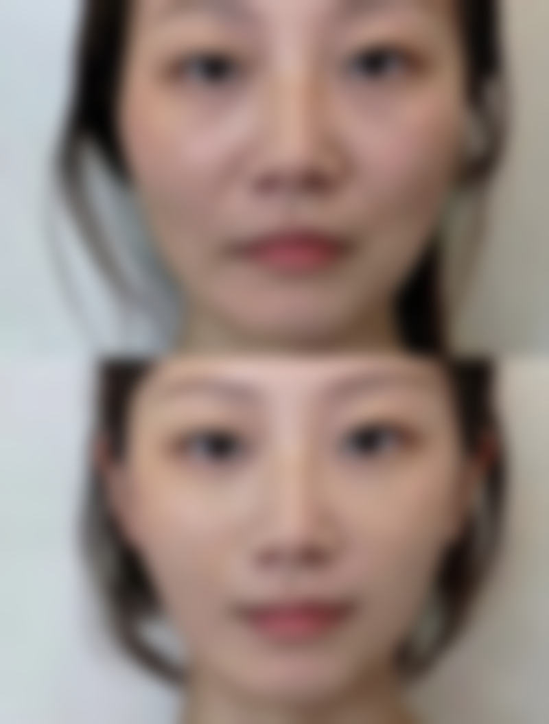 二、腿上抽脂带来的美观影响