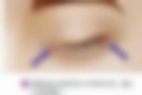 六、无痕去眼袋的修复情况