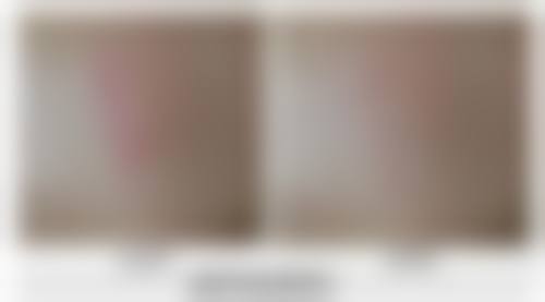 五、延长埋线双眼皮成效的秘诀