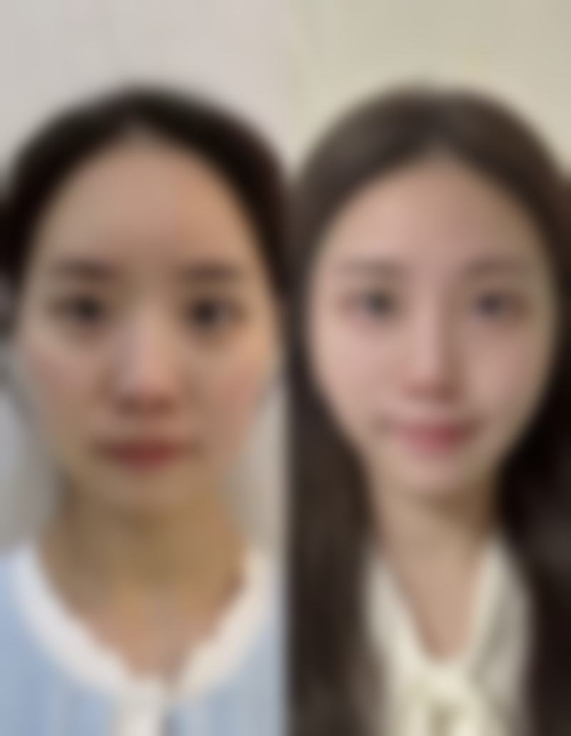 八、总结——埋线双眼皮会变成恒久吗？