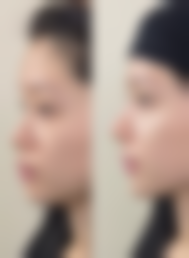 三、瘦脸针副作用出现时间及其他注意事项