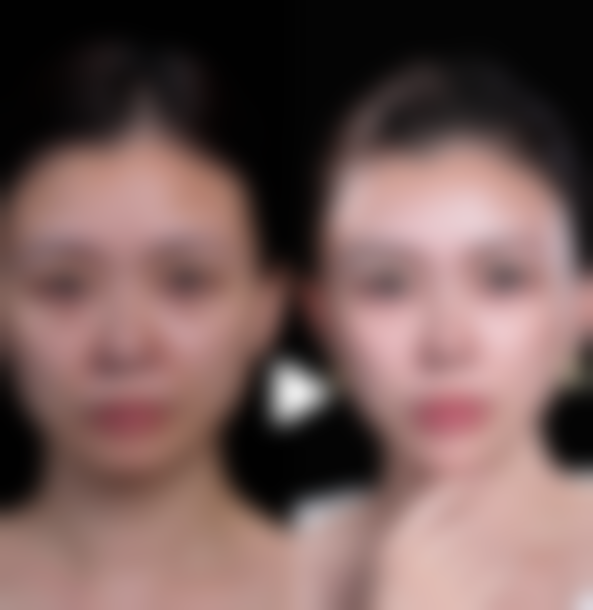 二、影响瘦脸针副作用消失时间的因素