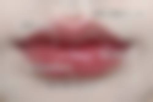 三、葡聚糖隆鼻与手术隆鼻的对比