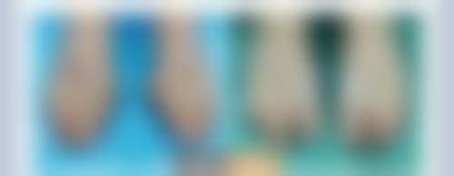 一、做隆胸后侧身睡觉时间的大致范围