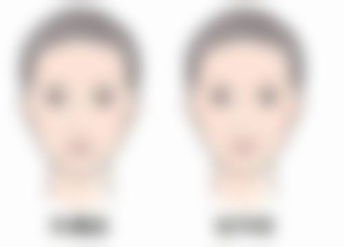 什么药膏可以去除疤痕黑色素沉淀？多款有效药膏及使用注意事项揭秘！ 