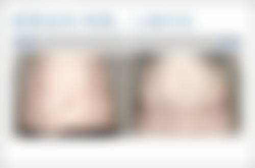 一、葡聚糖隆鼻概述