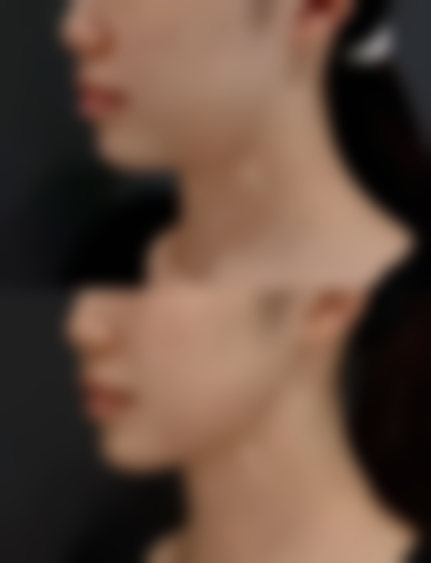 二、影响隆胸假体寿命的常见因素