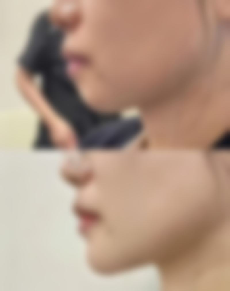 做隆胸后多久可以侧身睡觉？恢复时间因人而异，关键要点全解析！ 